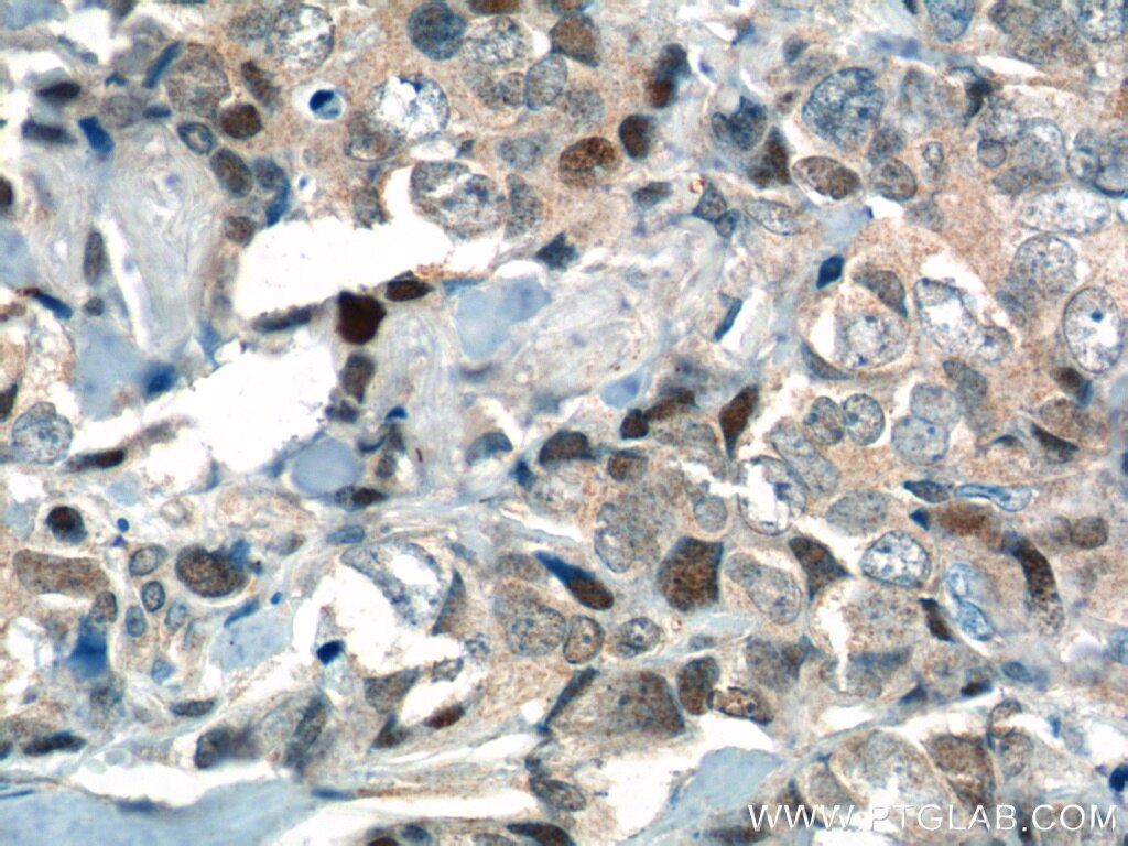 Immunohistochemistry (IHC) staining of human breast cancer tissue using KI67 Polyclonal antibody (19972-1-AP)
