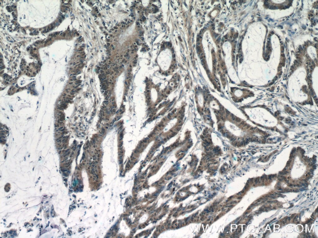 Immunohistochemistry (IHC) staining of human colon cancer tissue using KIAA0087 Polyclonal antibody (24973-1-AP)