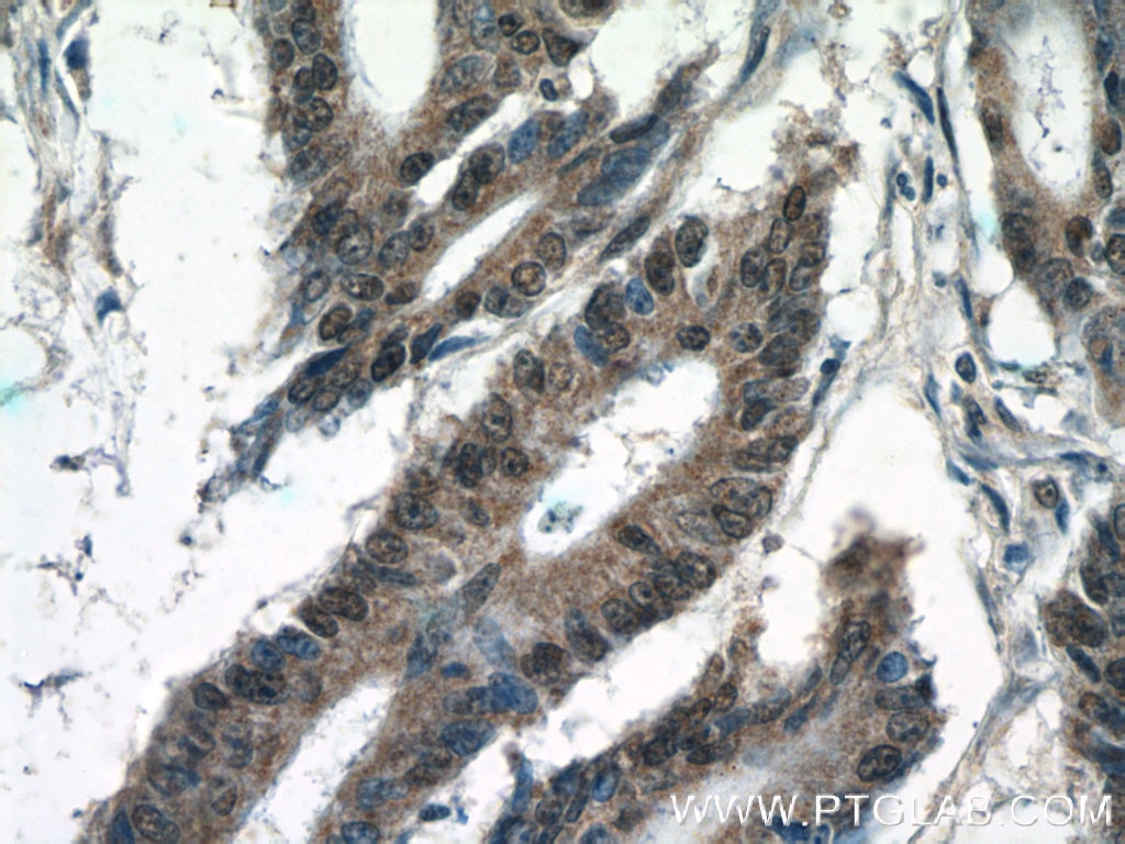 Immunohistochemistry (IHC) staining of human colon cancer tissue using KIAA0087 Polyclonal antibody (24973-1-AP)