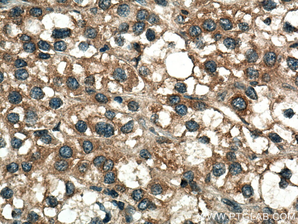Immunohistochemistry (IHC) staining of human liver cancer tissue using KIAA0090 Polyclonal antibody (26017-1-AP)
