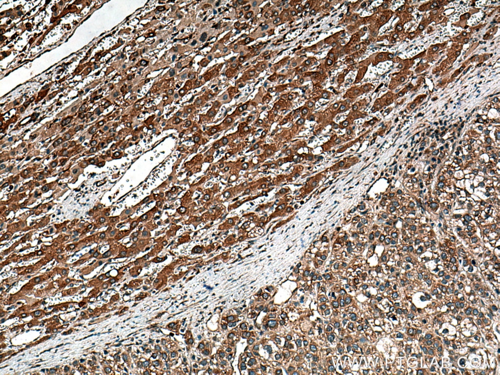 Immunohistochemistry (IHC) staining of human liver cancer tissue using KIAA0090 Polyclonal antibody (26017-1-AP)