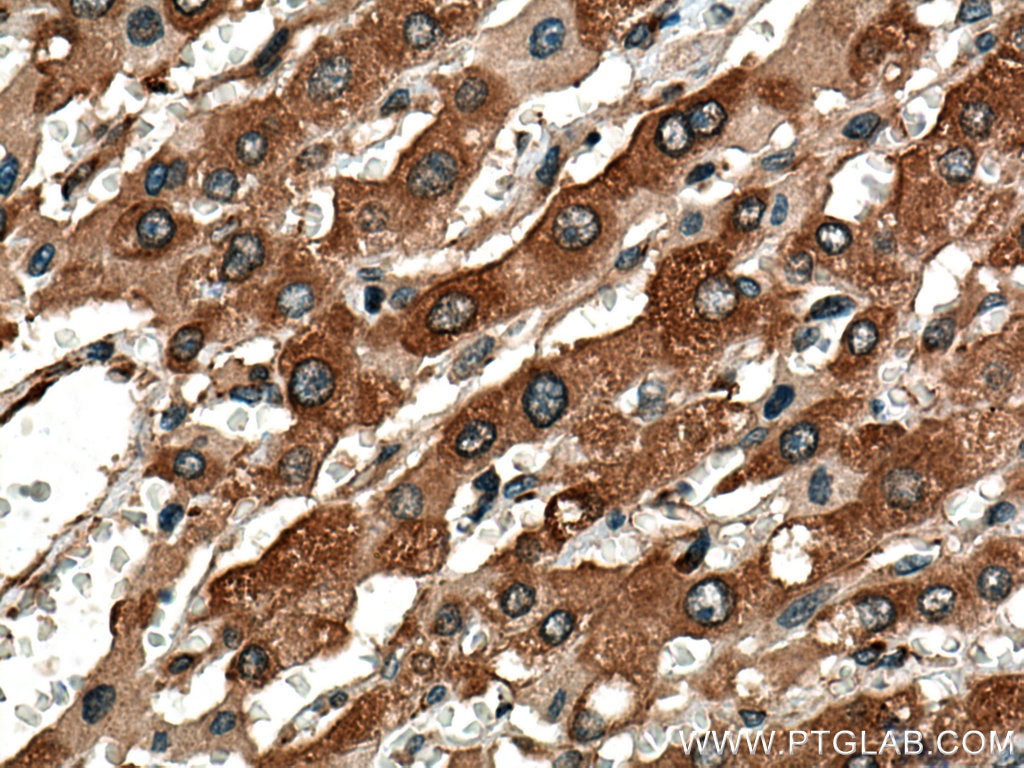 IHC staining of human liver cancer using 26017-1-AP