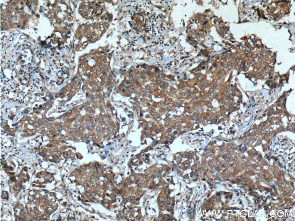 Immunohistochemistry (IHC) staining of human breast cancer tissue using KIAA0090 Polyclonal antibody (26017-1-AP)