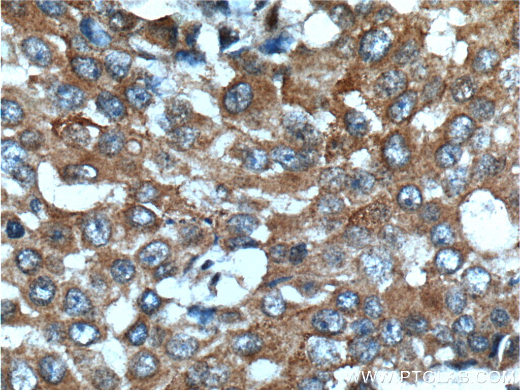 IHC staining of human breast cancer using 26017-1-AP