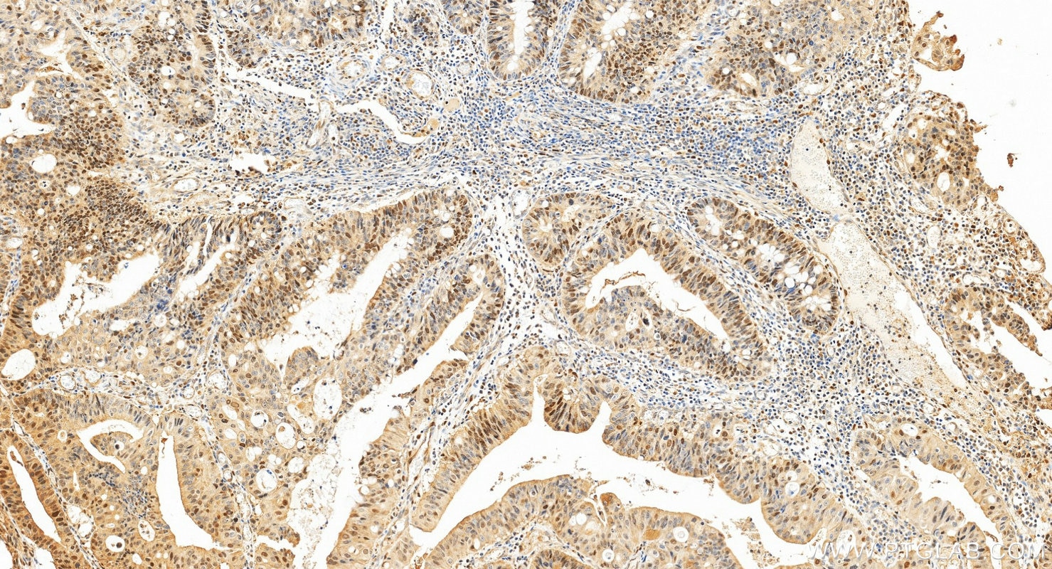 IHC staining of human colon cancer using 20537-1-AP Immunohistochemistry (IHC) staining of human colon cancer tissue using PAF15 Polyclonal antibody (20537-1-AP)