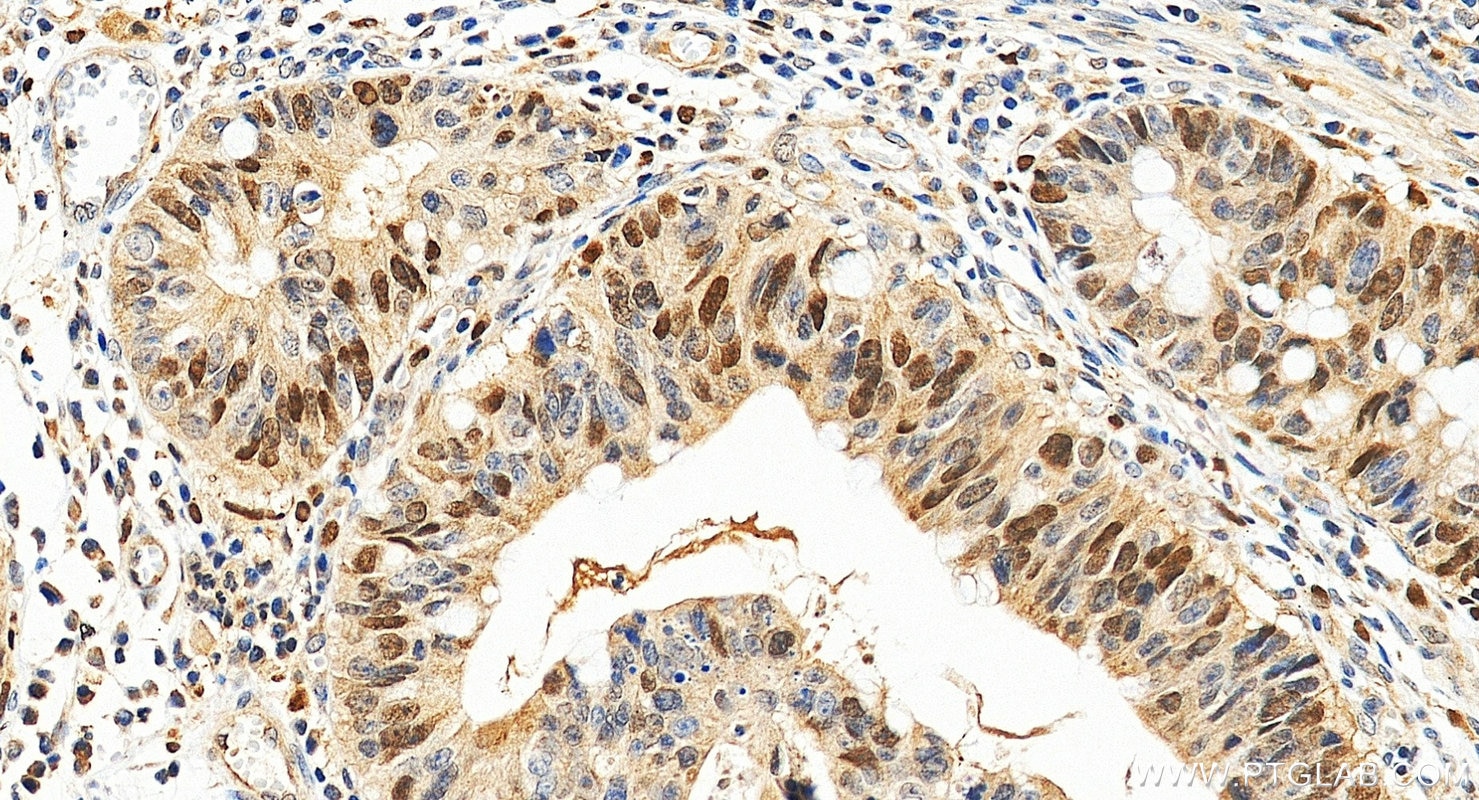 IHC staining of human colon cancer using 20537-1-AP Immunohistochemistry (IHC) staining of human colon cancer tissue using PAF15 Polyclonal antibody (20537-1-AP)