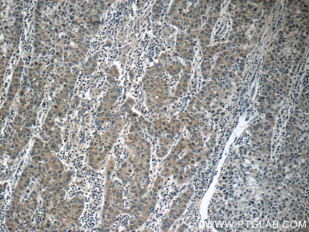 IHC staining of human liver cancer using 25195-1-AP