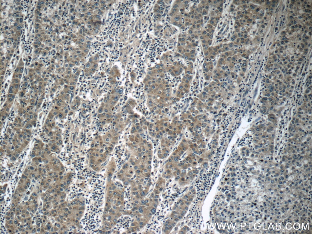 Immunohistochemistry (IHC) staining of human liver cancer tissue using KIAA0125 Polyclonal antibody (25195-1-AP)