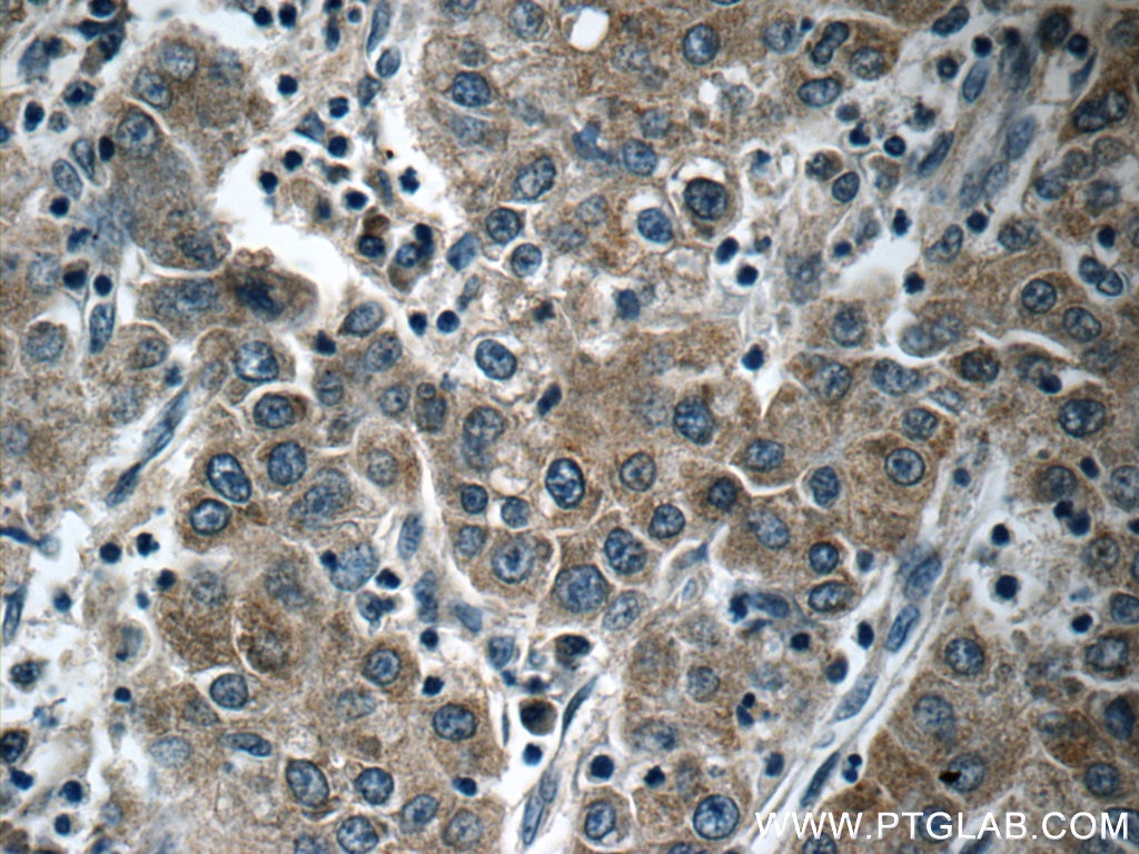 Immunohistochemistry (IHC) staining of human liver cancer tissue using KIAA0125 Polyclonal antibody (25195-1-AP)