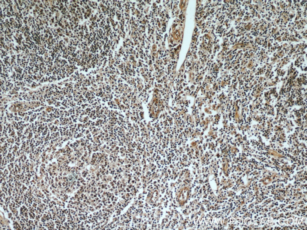 Immunohistochemistry (IHC) staining of human tonsillitis tissue using Rubicon Polyclonal antibody (21444-1-AP)