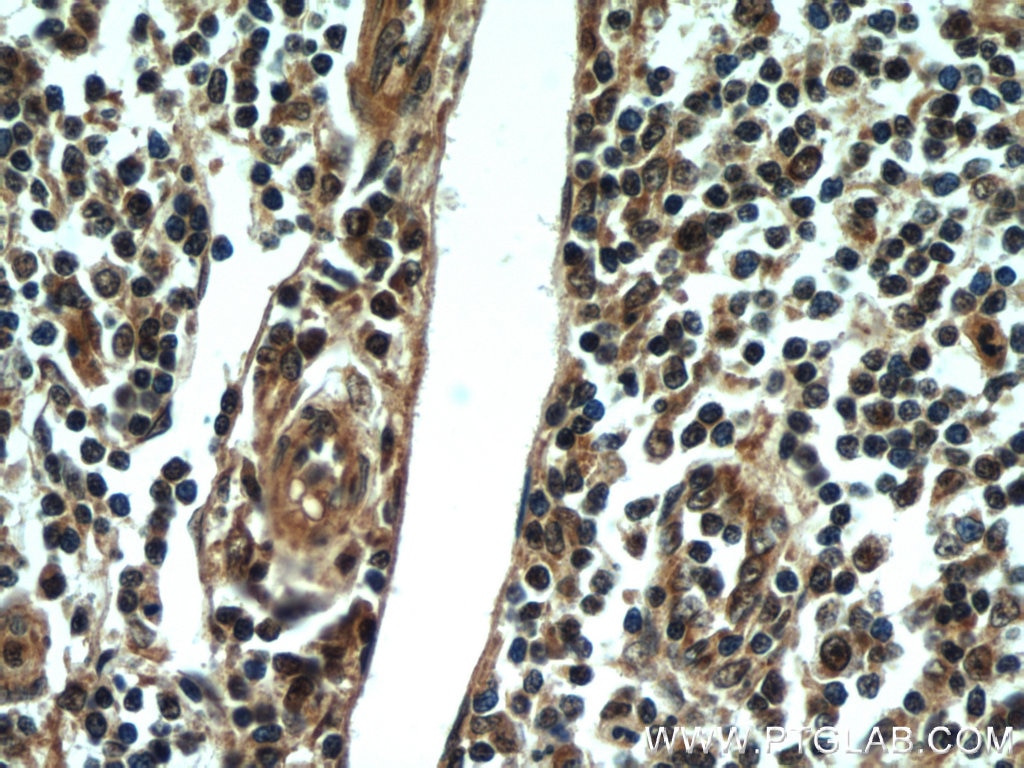 Immunohistochemistry (IHC) staining of human tonsillitis tissue using Rubicon Polyclonal antibody (21444-1-AP)