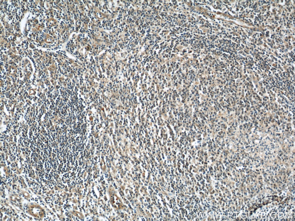 Immunohistochemistry (IHC) staining of human tonsillitis tissue using Rubicon Polyclonal antibody (21444-1-AP)