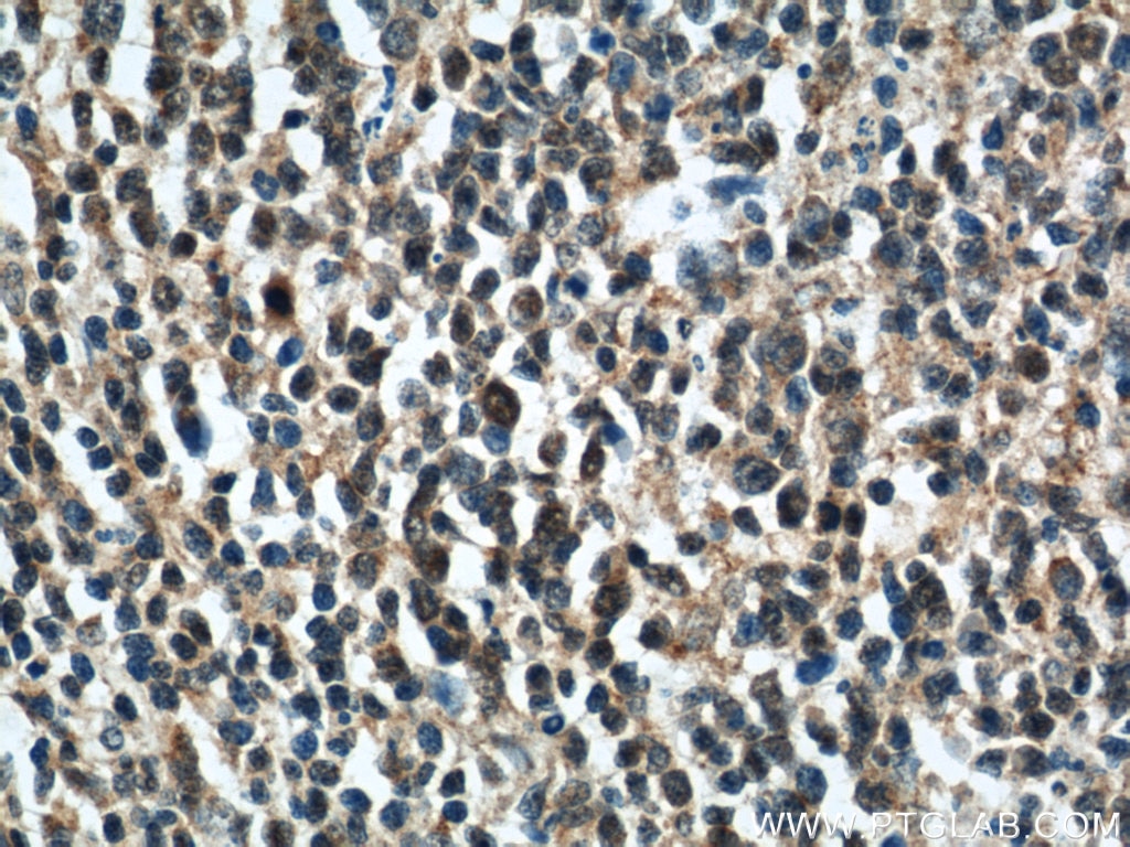Immunohistochemistry (IHC) staining of human tonsillitis tissue using Rubicon Polyclonal antibody (21444-1-AP)