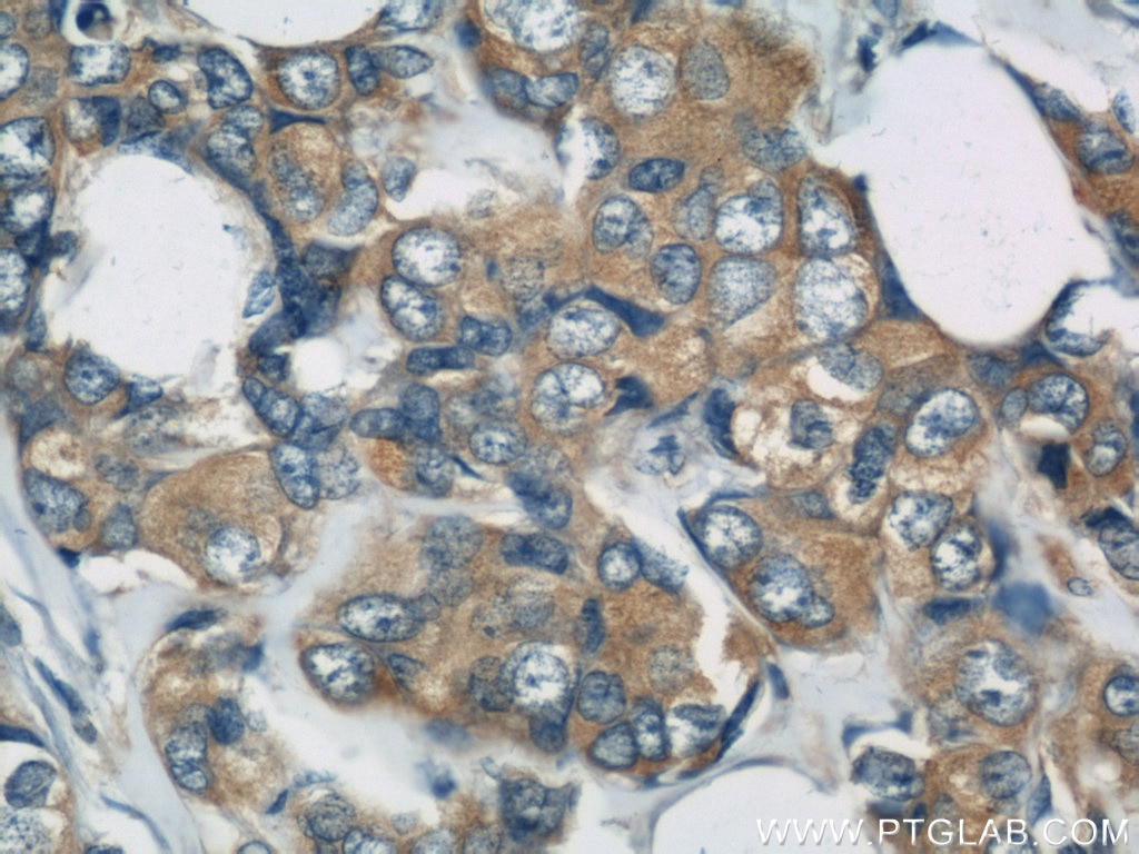 Immunohistochemistry (IHC) staining of human breast cancer tissue using DYNC1H1 Polyclonal antibody (12345-1-AP)