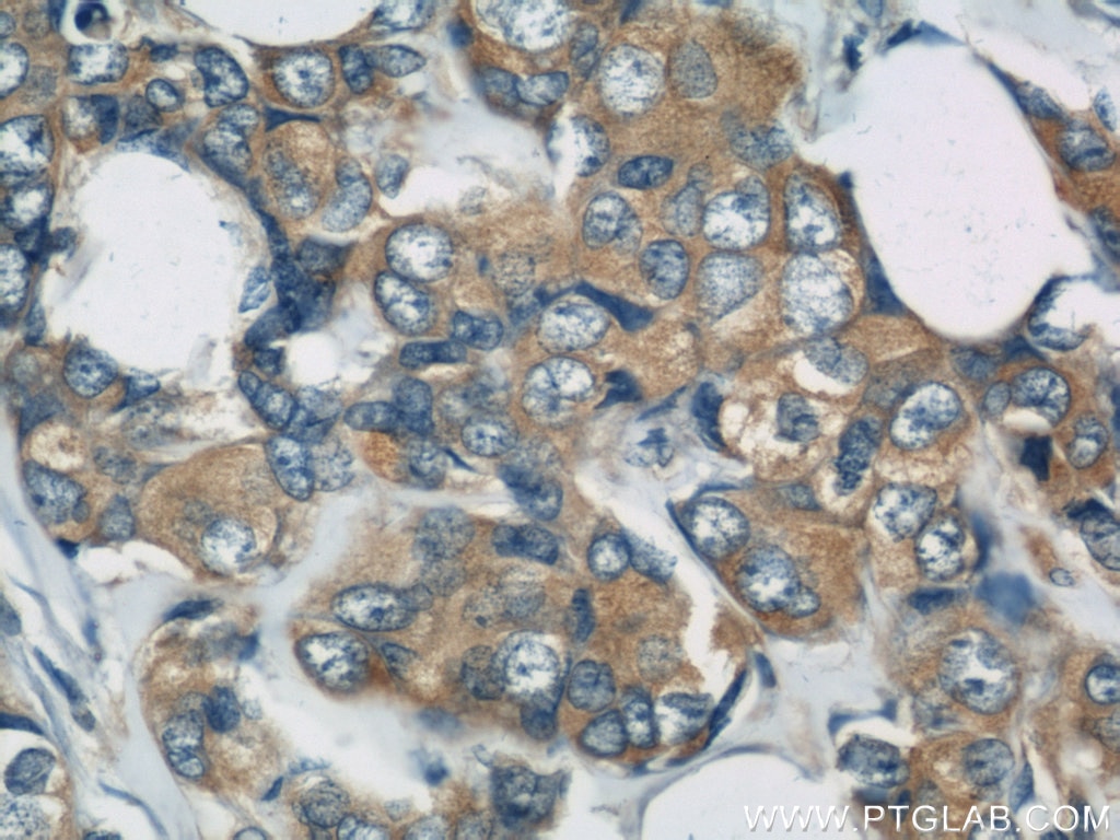 IHC staining of human breast cancer using 12345-1-AP