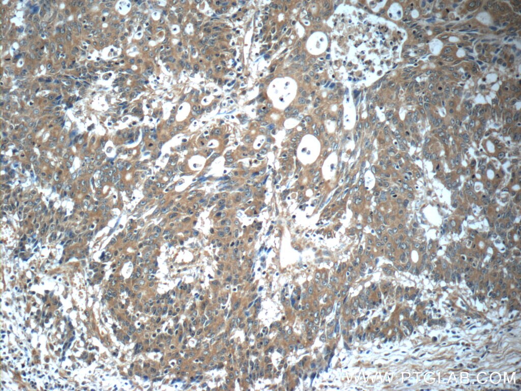 Immunohistochemistry (IHC) staining of human colon cancer tissue using KIAA0841 Polyclonal antibody (25721-1-AP)