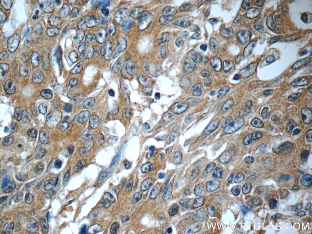 Immunohistochemistry (IHC) staining of human colon cancer tissue using KIAA0841 Polyclonal antibody (25721-1-AP)