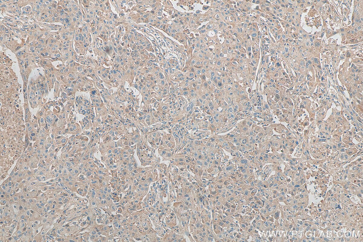 Immunohistochemistry (IHC) staining of human lung cancer tissue using KIAA0907 Polyclonal antibody (25419-1-AP)