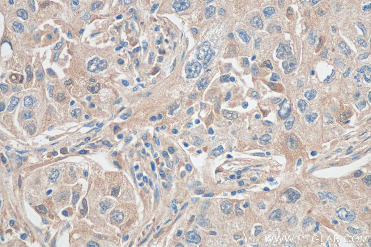 Immunohistochemistry (IHC) staining of human lung cancer tissue using KIAA0907 Polyclonal antibody (25419-1-AP)