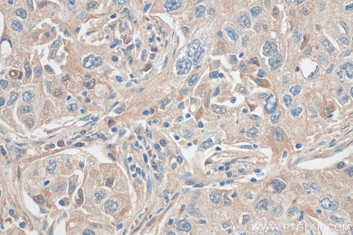 Immunohistochemistry (IHC) staining of human lung cancer tissue using KIAA0907 Polyclonal antibody (25419-1-AP)
