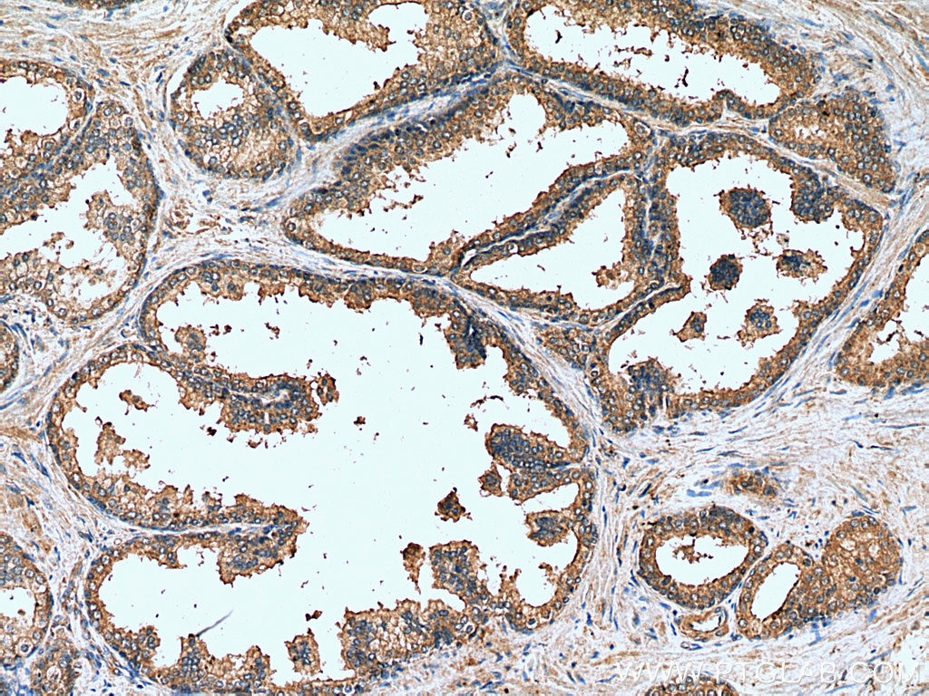 Immunohistochemistry (IHC) staining of human prostate hyperplasia tissue using KIAA1199 / CEMIP  Polyclonal antibody (21129-1-AP)