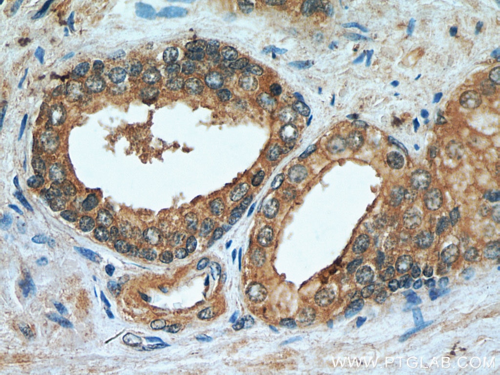 Immunohistochemistry (IHC) staining of human prostate hyperplasia tissue using KIAA1199 / CEMIP  Polyclonal antibody (21129-1-AP)