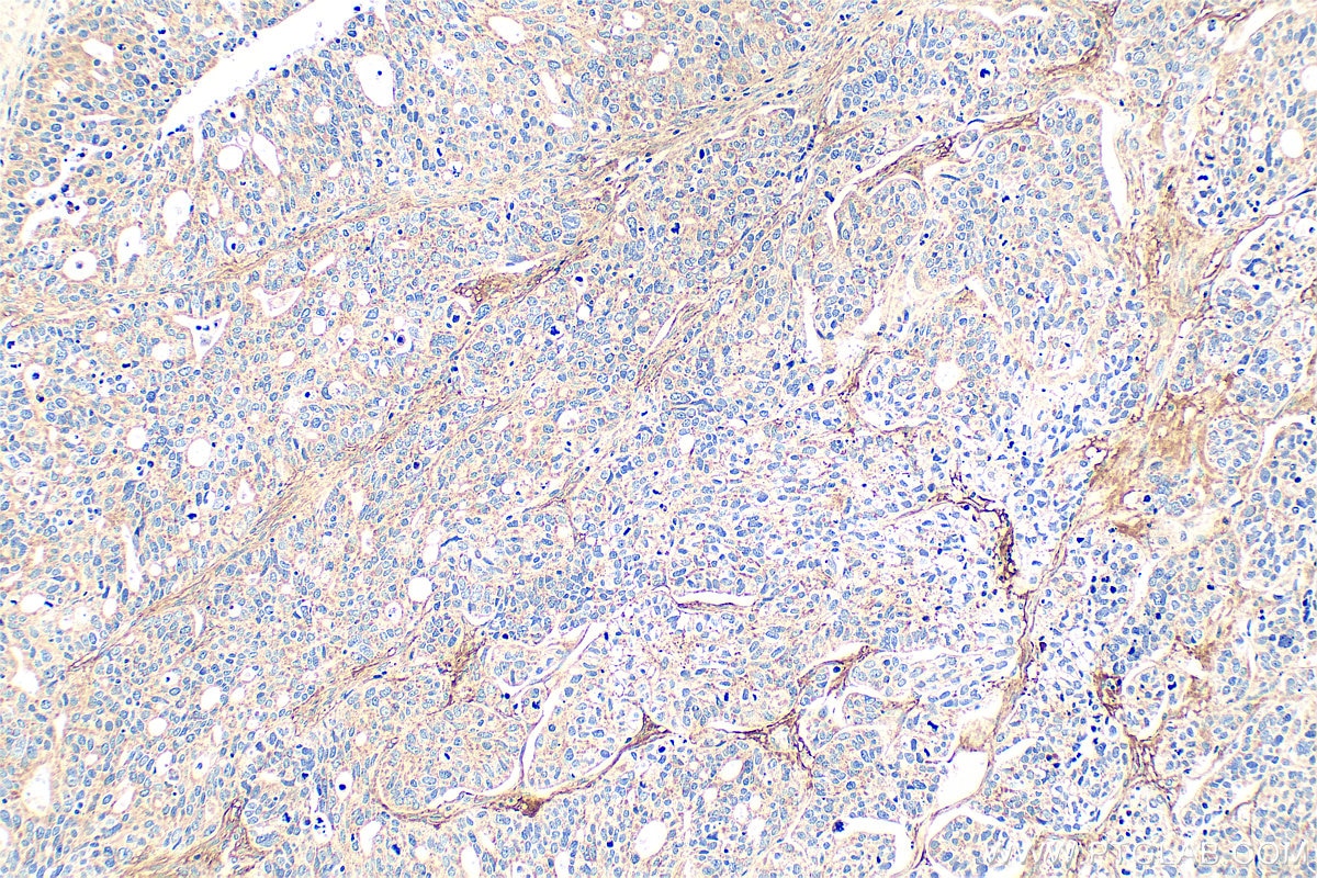 Immunohistochemical analysis of paraffin-embedded human ovary tumor tissue slide using 21129-1-AP (KIAA1199 / CEMIP antibody) at dilution of 1:200 (under 10x lens). Heat mediated antigen retrieval with Tris-EDTA buffer (pH 9.0). Immunohistochemistry (IHC) staining of human ovary tumor tissue using KIAA1199 / CEMIP Polyclonal antibody (21129-1-AP)