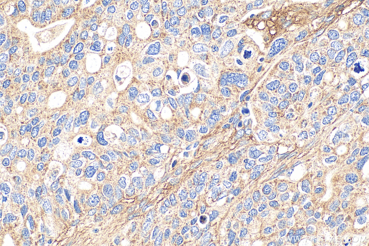 Immunohistochemical analysis of paraffin-embedded human ovary tumor tissue slide using 21129-1-AP (KIAA1199 / CEMIP antibody) at dilution of 1:200 (under 40x lens). Heat mediated antigen retrieval with Tris-EDTA buffer (pH 9.0). Immunohistochemistry (IHC) staining of human ovary tumor tissue using KIAA1199 / CEMIP Polyclonal antibody (21129-1-AP)