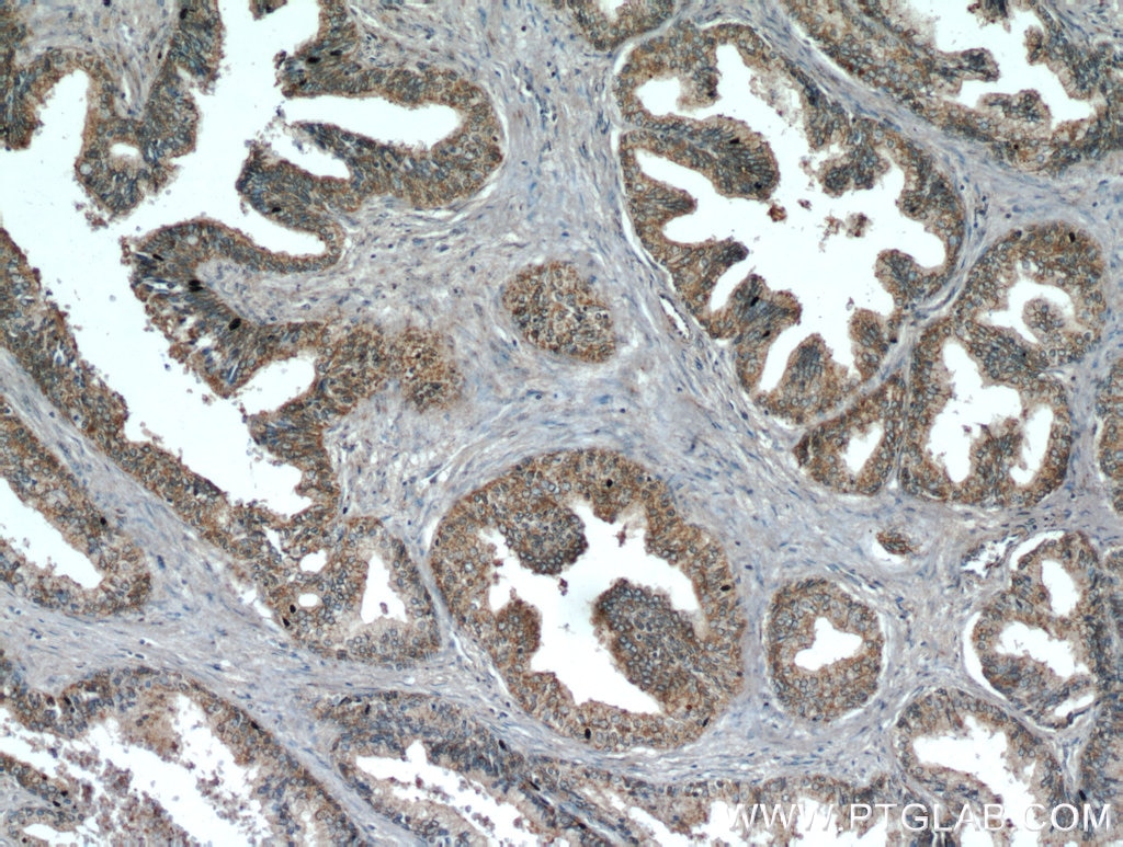 Immunohistochemistry (IHC) staining of human prostate hyperplasia tissue using KIAA1199 / CEMIP  Polyclonal antibody (21129-1-AP)