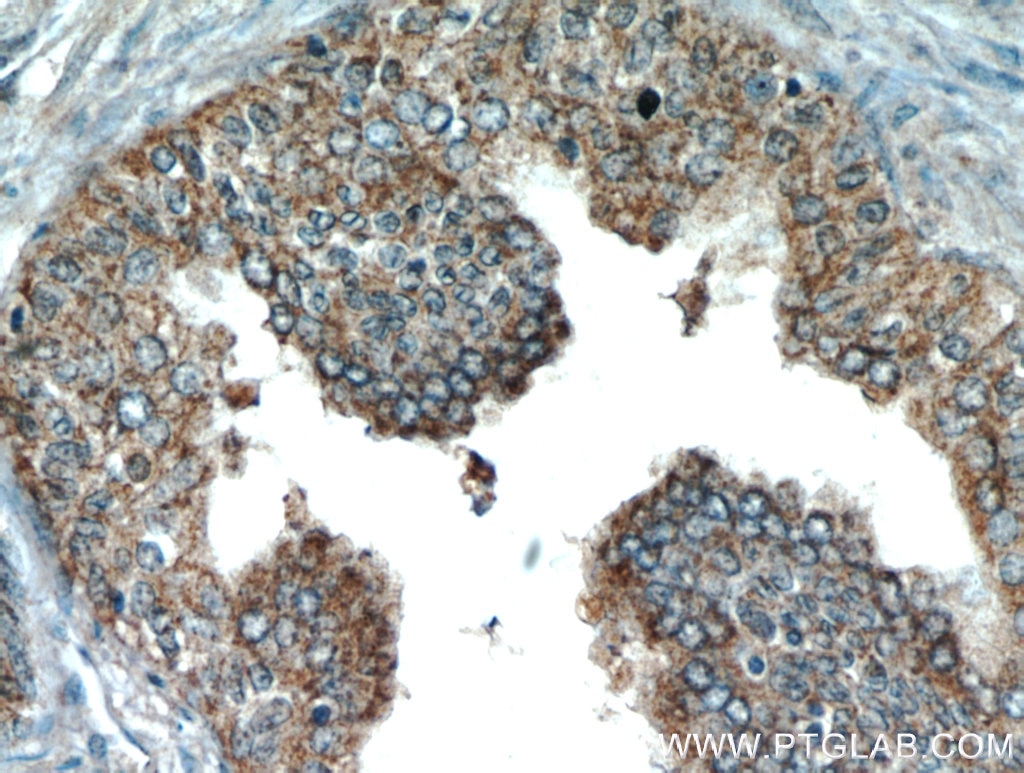 Immunohistochemistry (IHC) staining of human prostate hyperplasia tissue using KIAA1199 / CEMIP  Polyclonal antibody (21129-1-AP)
