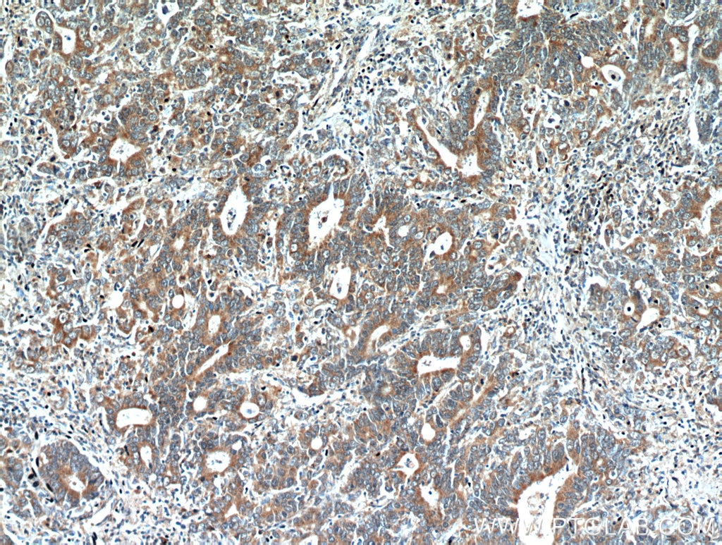 IHC staining of human stomach cancer using 21129-1-AP