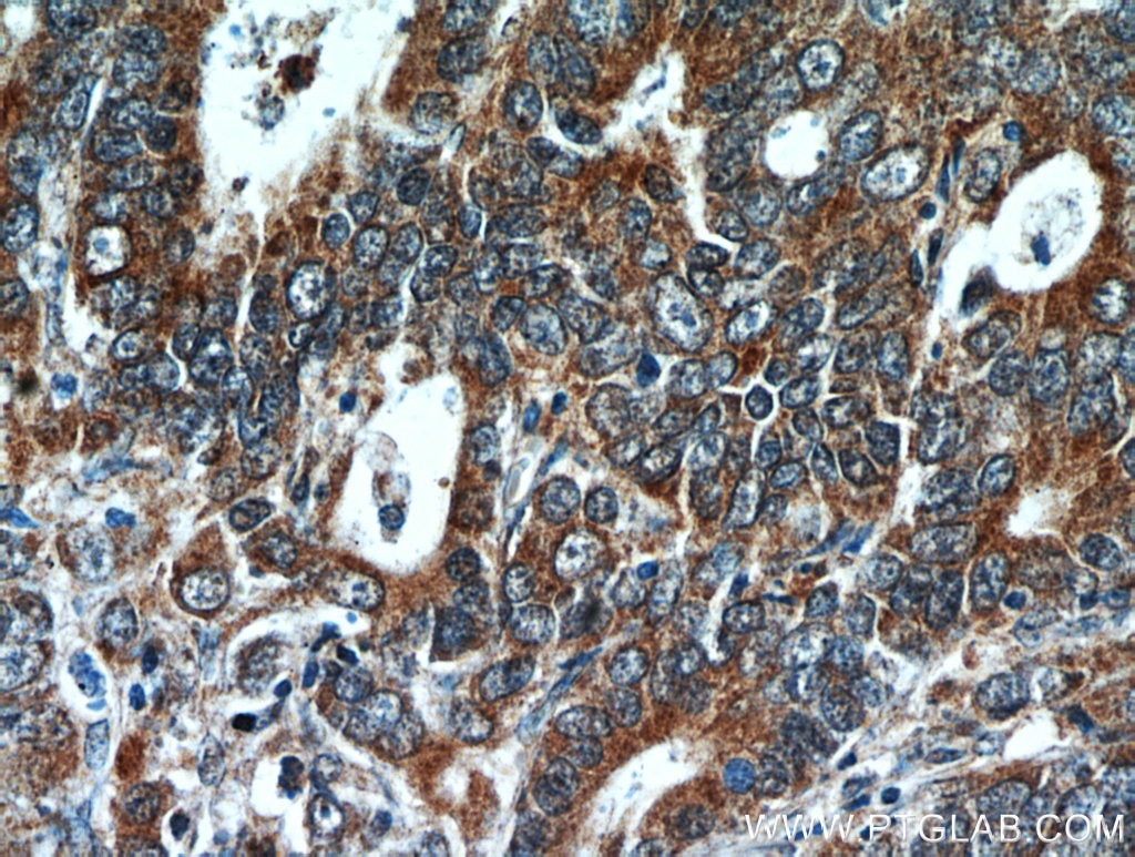 IHC staining of human stomach cancer using 21129-1-AP