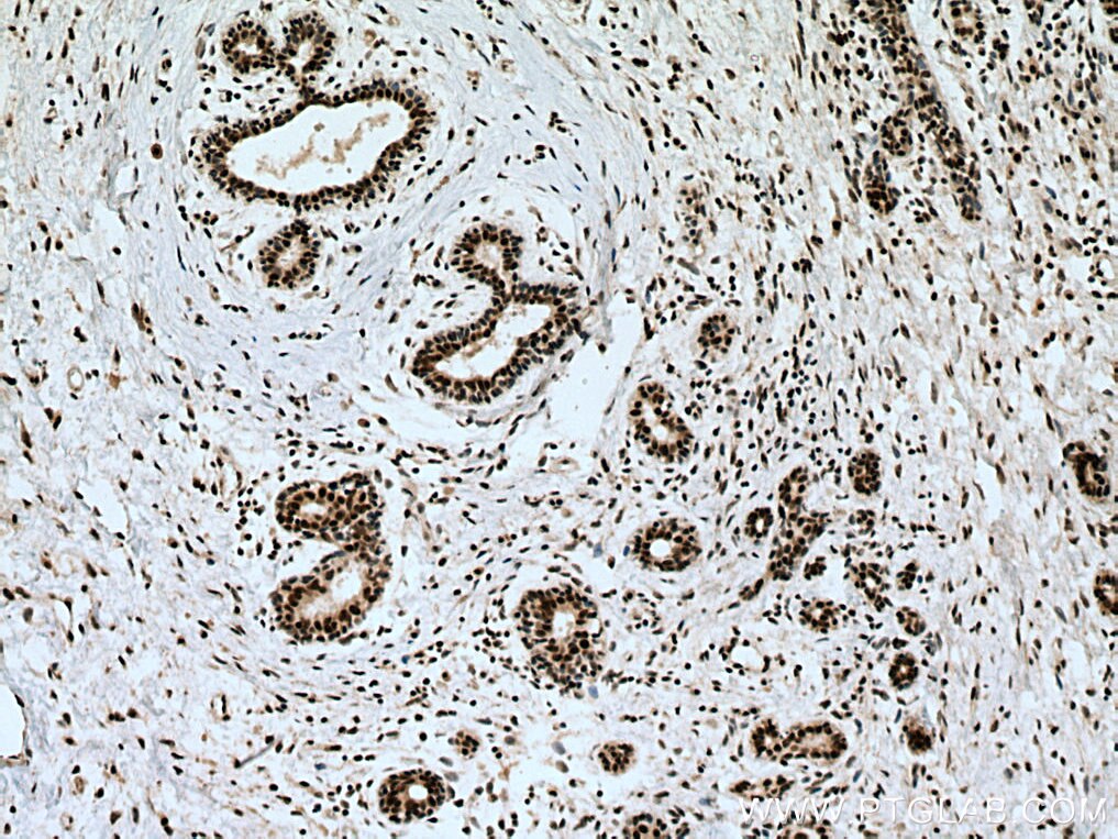 Immunohistochemistry (IHC) staining of human breast cancer tissue using VIRMA/KIAA1429 Polyclonal antibody (25712-1-AP)