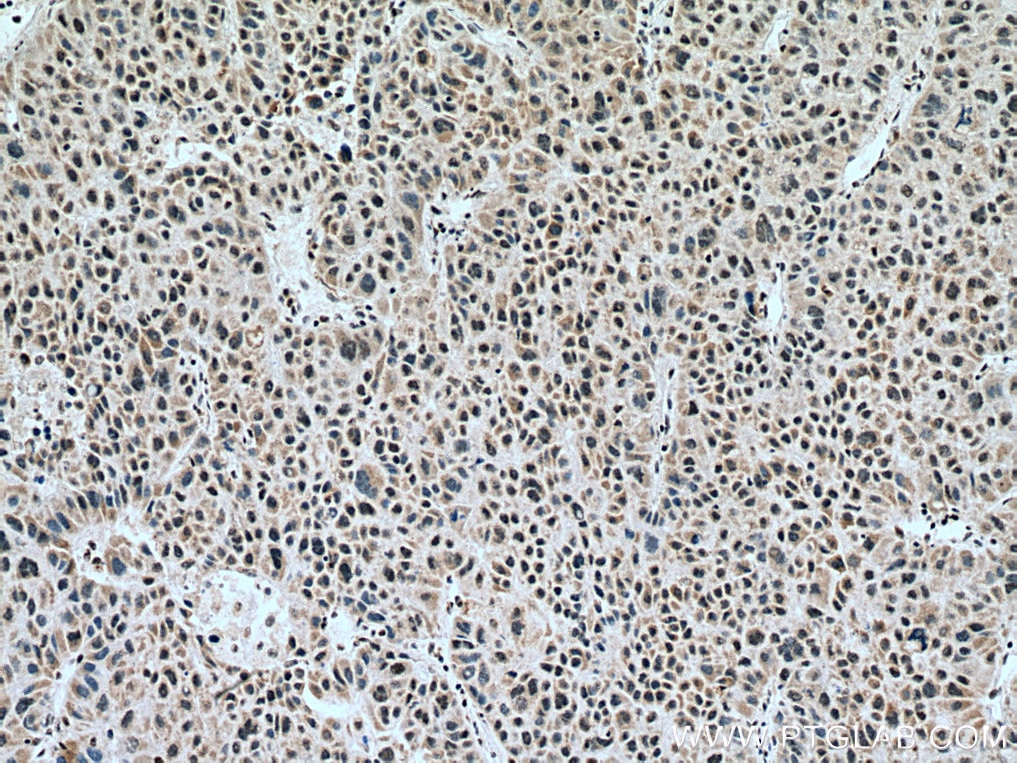 Immunohistochemistry (IHC) staining of human liver cancer tissue using VIRMA/KIAA1429 Polyclonal antibody (25712-1-AP)