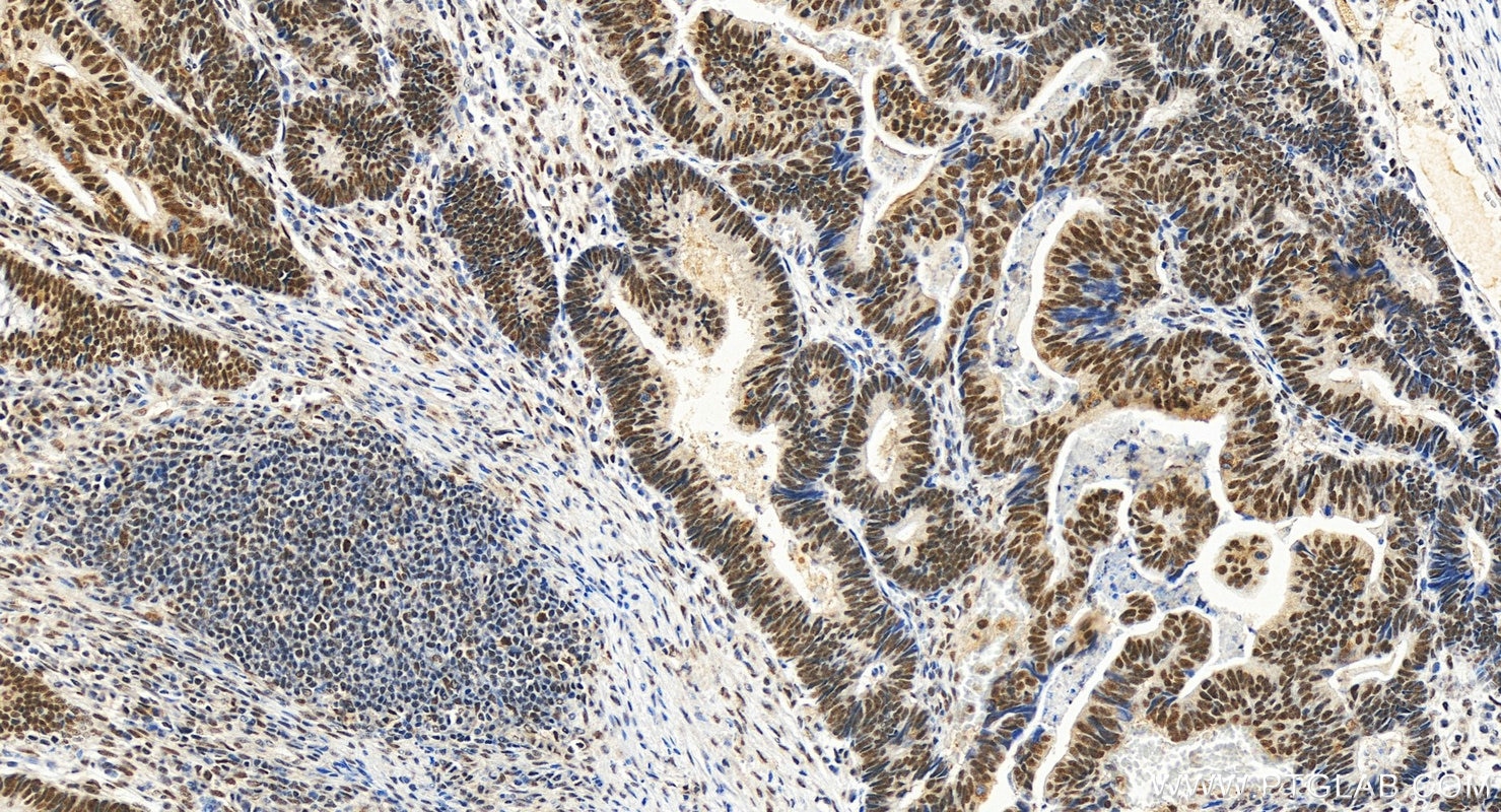Immunohistochemistry (IHC) staining of human colon cancer tissue using KIAA1429 Monoclonal antibody (68235-1-Ig)