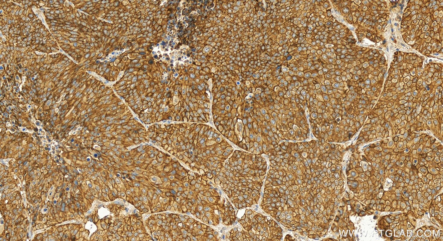Immunohistochemistry (IHC) staining of human lung squamous cell carcinoma tissue using KIAA1522 Polyclonal antibody (31198-1-AP)