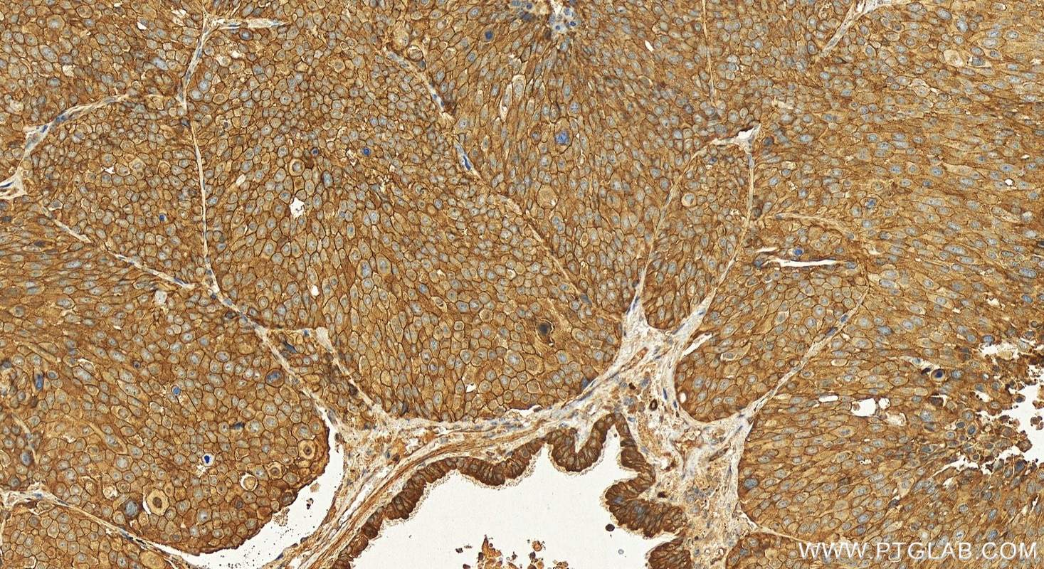 Immunohistochemistry (IHC) staining of human lung squamous cell carcinoma tissue using KIAA1522 Polyclonal antibody (31198-1-AP)