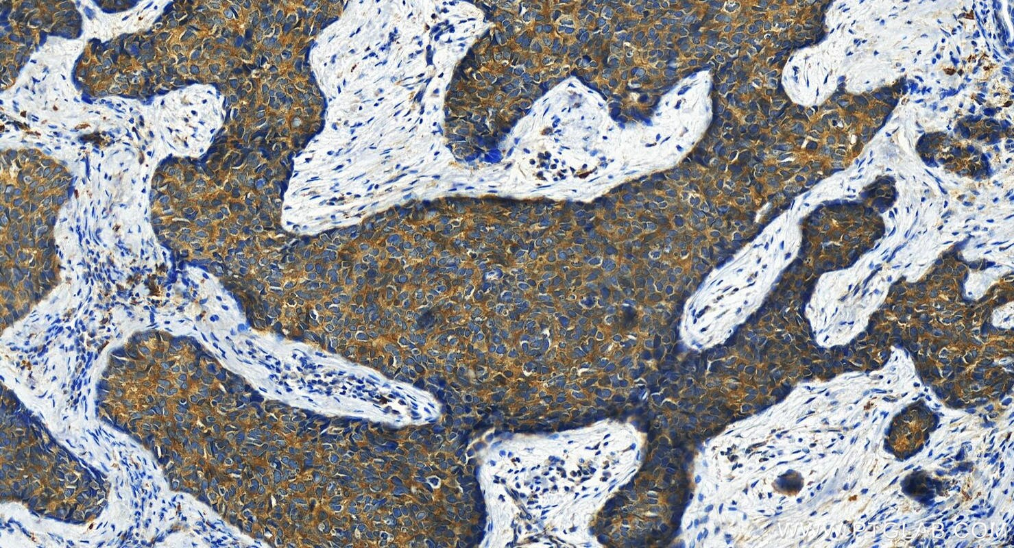 Immunohistochemistry (IHC) staining of human bowen disease tissue using Shootin 1 Polyclonal antibody (24383-1-AP)