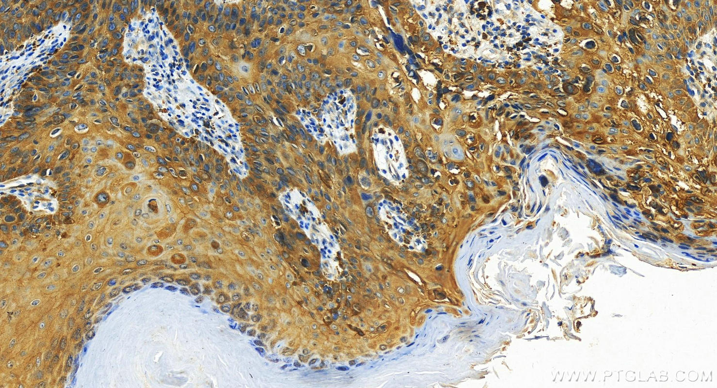Immunohistochemistry (IHC) staining of human bowen disease tissue using Shootin 1 Polyclonal antibody (24383-1-AP)