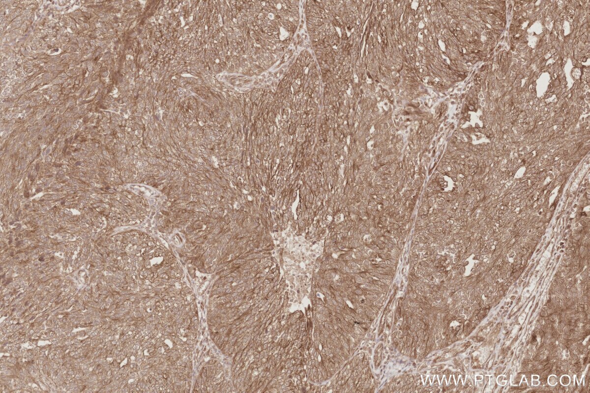 IHC staining of human ovary cancer using 24457-1-AP Immunohistochemistry (IHC) staining of human ovary cancer tissue using CEP44 Polyclonal antibody (24457-1-AP)