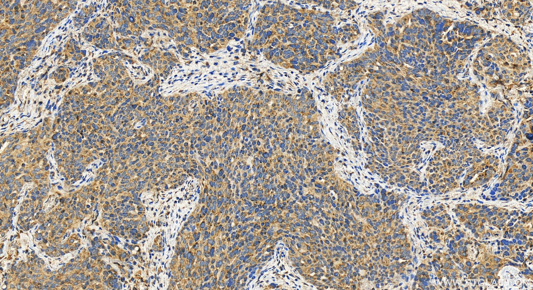 Immunohistochemistry (IHC) staining of human ovary cancer tissue using KIAA2013 Polyclonal antibody (27886-1-AP)