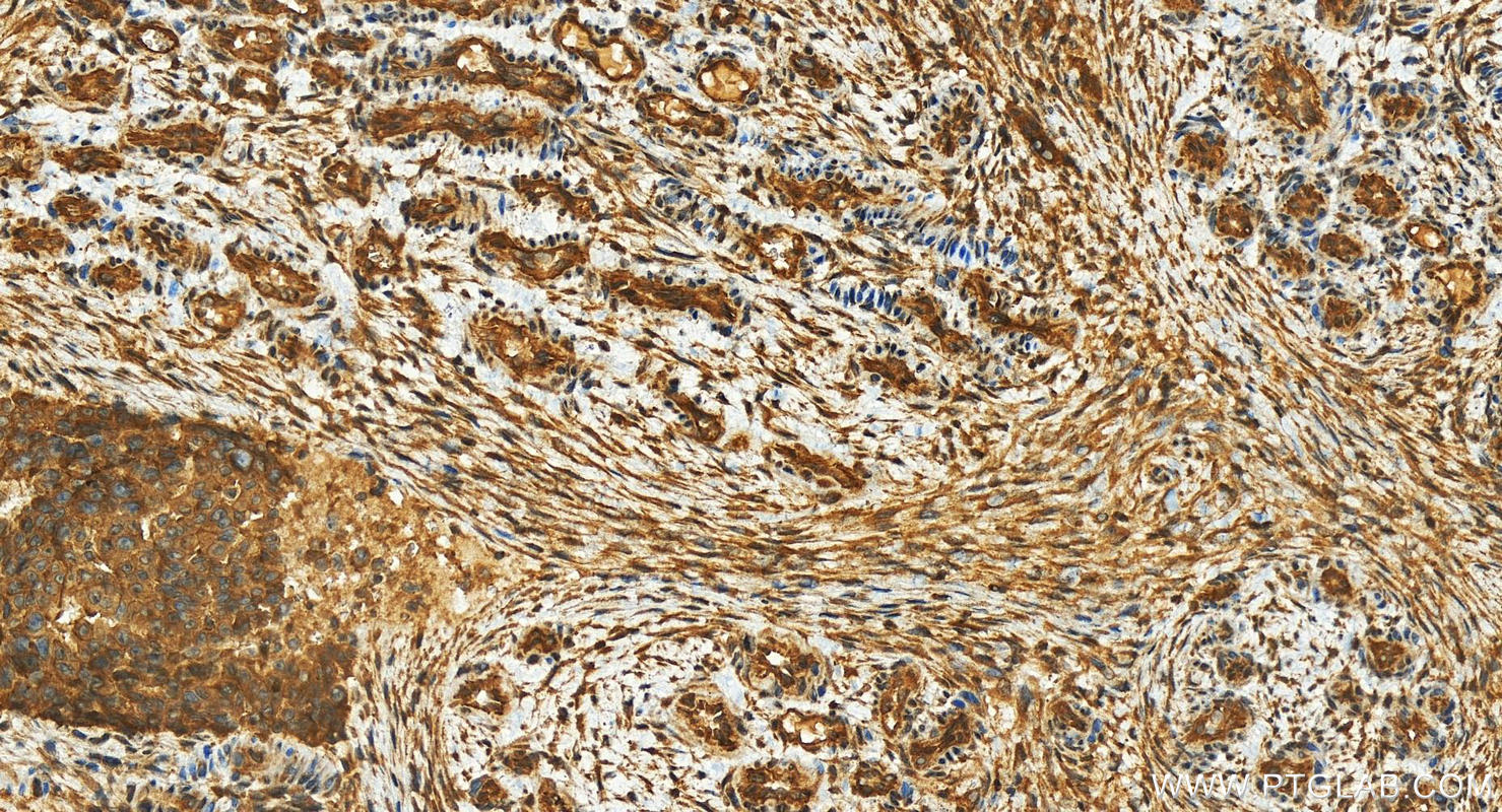 Immunohistochemistry (IHC) staining of human ovarian  cancer using KIDINS220 Polyclonal antibody (21856-1-AP)