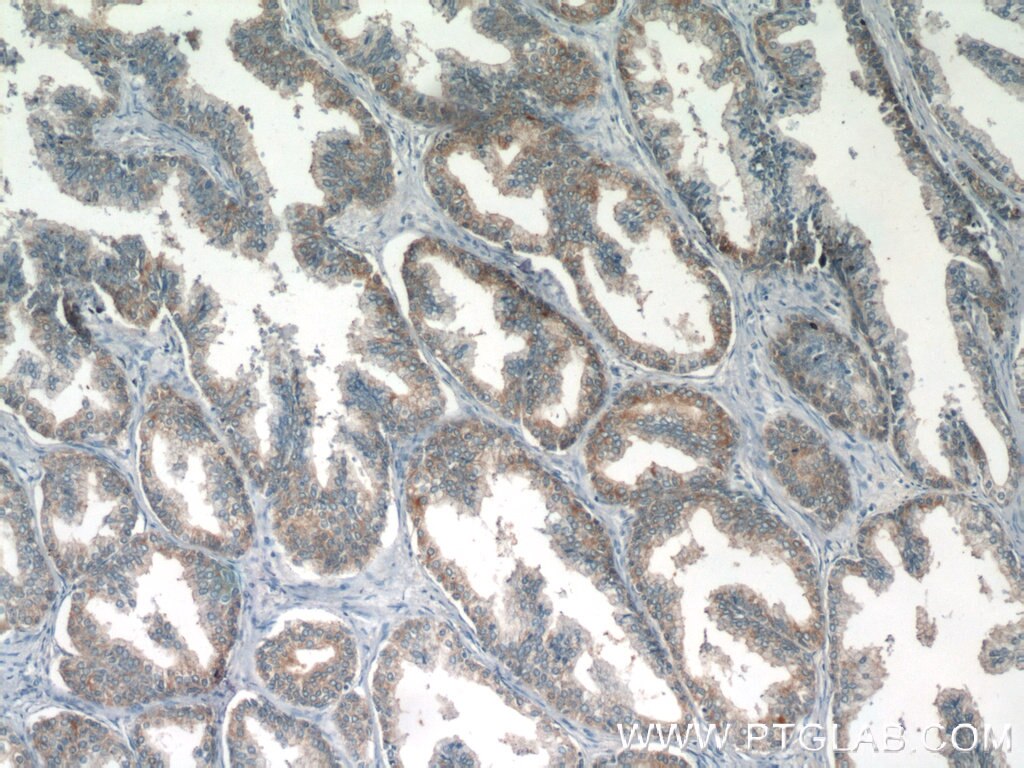 Immunohistochemistry (IHC) staining of human prostate hyperplasia tissue using Eg5 Polyclonal antibody (23333-1-AP)