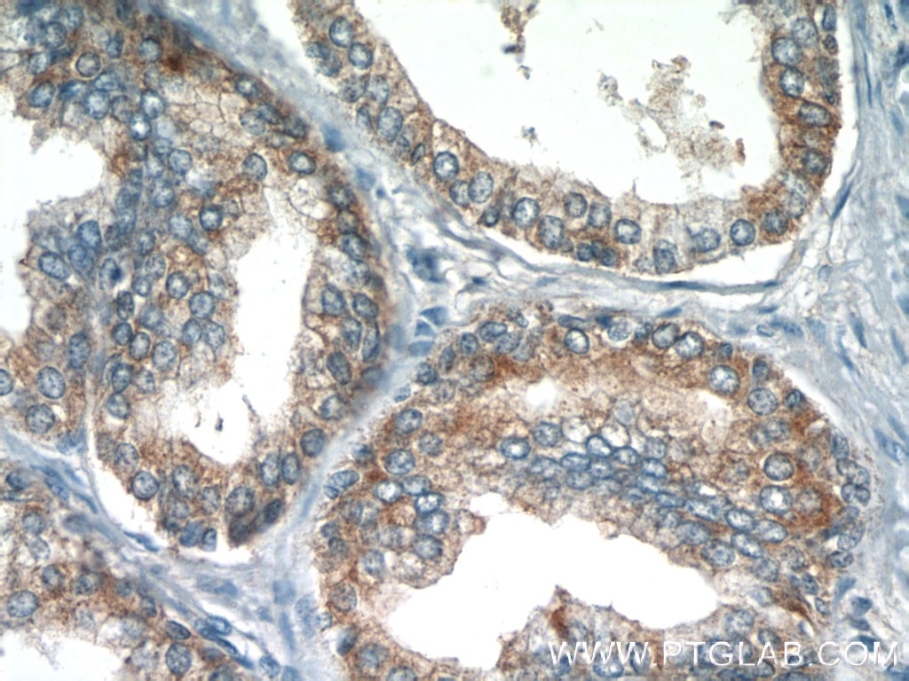Immunohistochemistry (IHC) staining of human prostate hyperplasia tissue using Eg5 Polyclonal antibody (23333-1-AP)