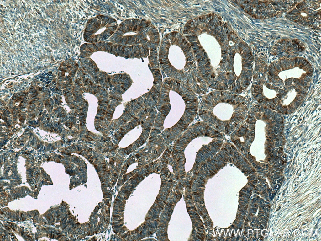 IHC staining of human endometrial cancer using 23333-1-AP