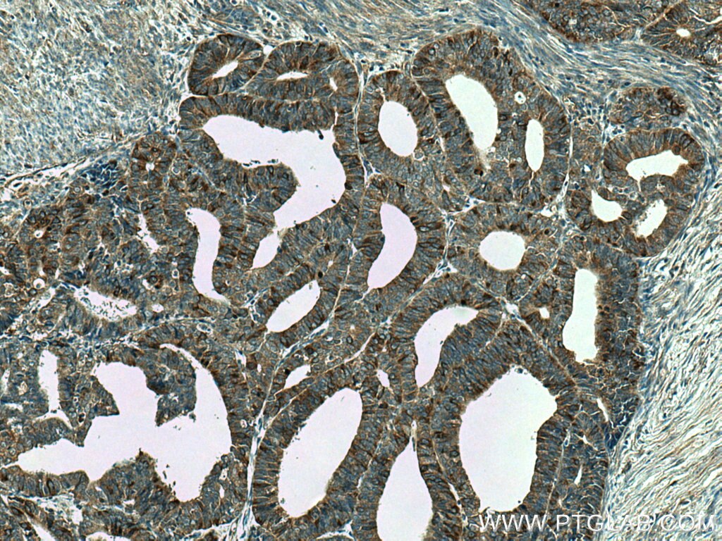 Immunohistochemistry (IHC) staining of human endometrial cancer tissue using Eg5 Polyclonal antibody (23333-1-AP)