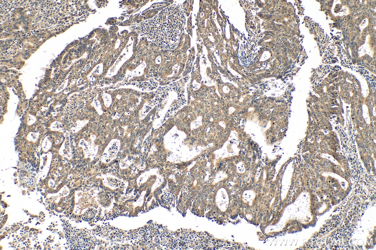 Immunohistochemistry (IHC) staining of human endometrial cancer tissue using Eg5 Polyclonal antibody (23333-1-AP)