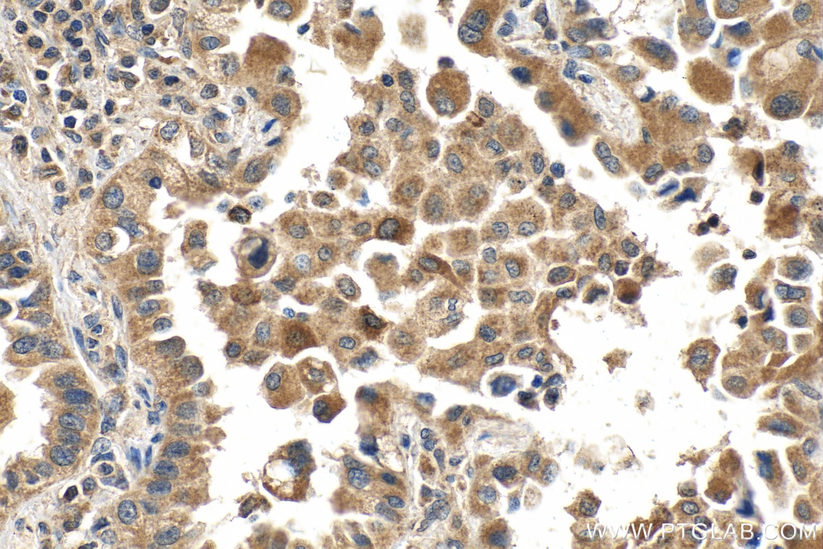 Immunohistochemistry (IHC) staining of human lung cancer tissue using Eg5 Polyclonal antibody (23333-1-AP)