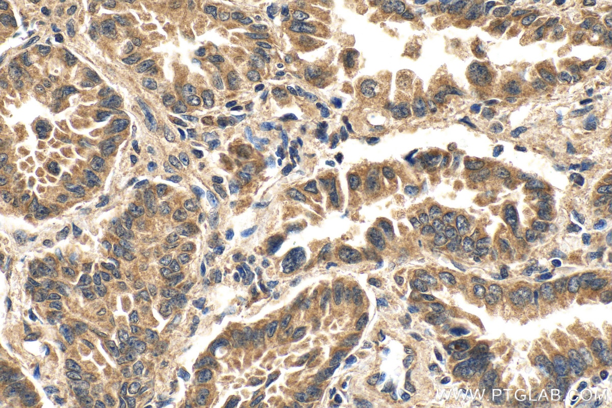 IHC staining of human lung cancer using 23333-1-AP