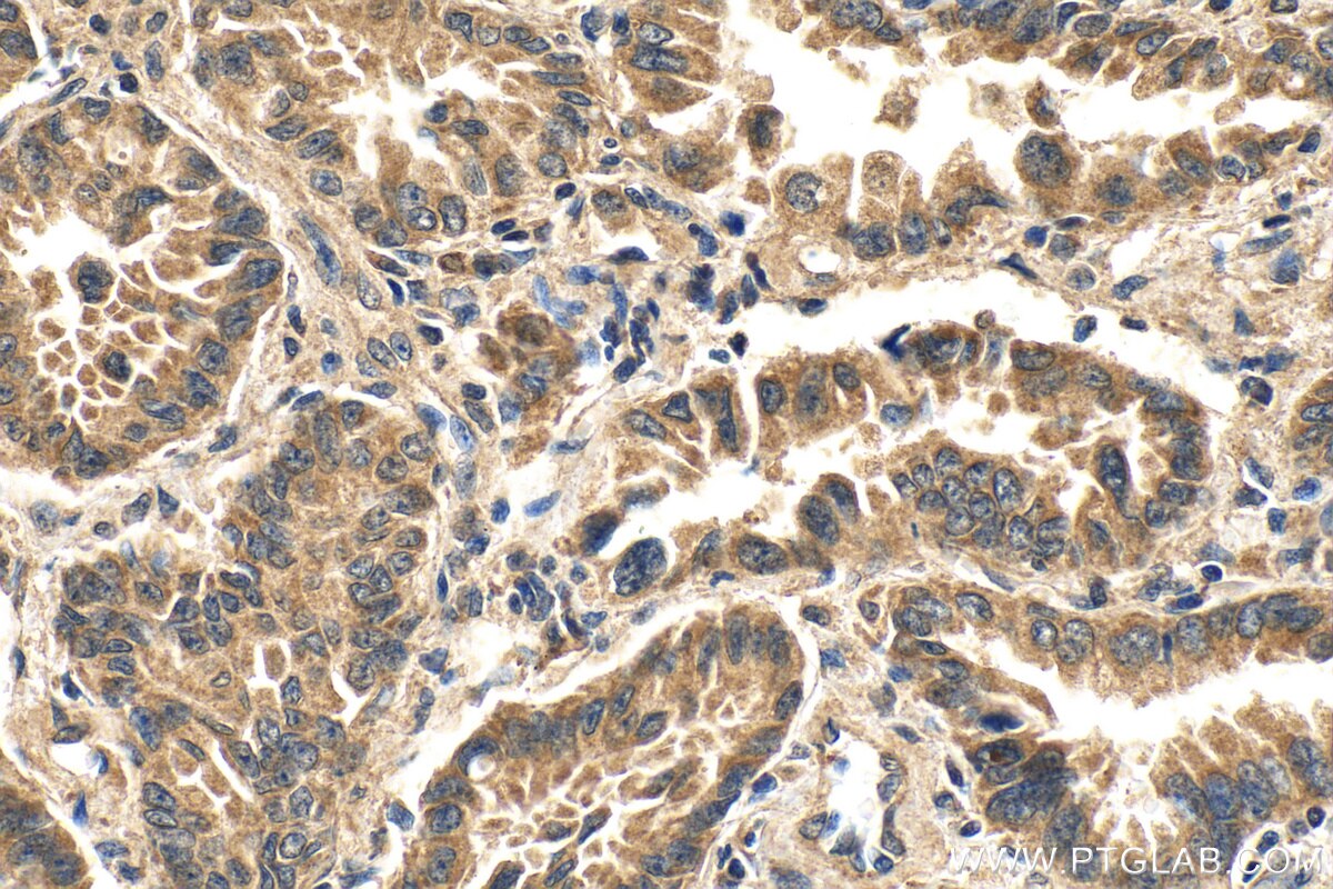 Immunohistochemistry (IHC) staining of human lung cancer tissue using Eg5 Polyclonal antibody (23333-1-AP)